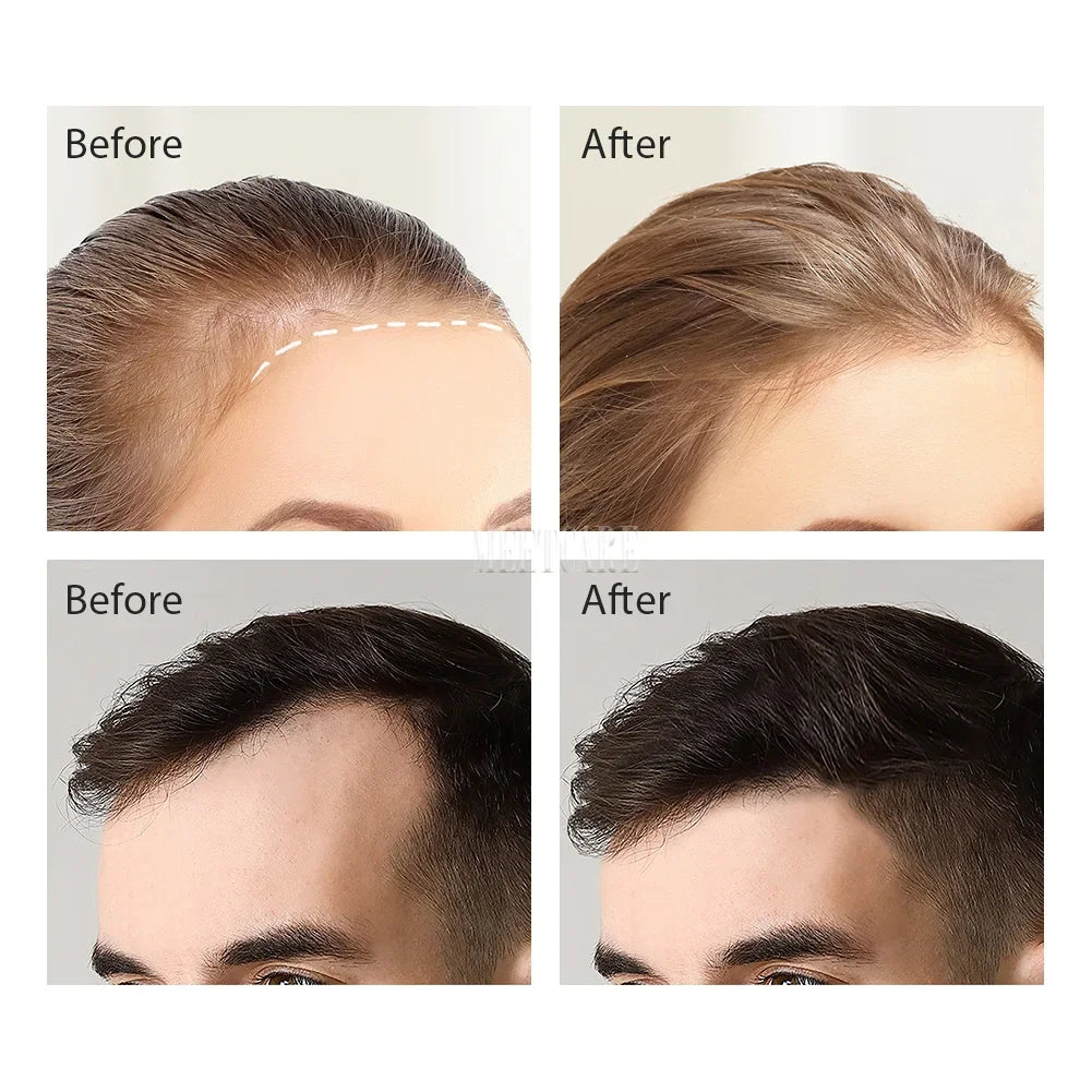 Bio 120pin Derma rouleau timbre ajuster aiguille Derma Microneedle stylo pour barbe croissance des cheveux Microneedling Dermaroller soins de la peau